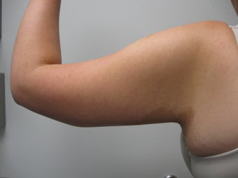 Arm Lift after 388987