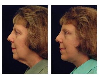 Lower Face and Neck Lift 355119