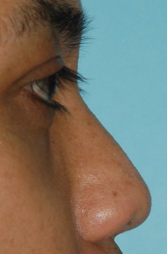 Non Surgical Rhinoplasty before 307848