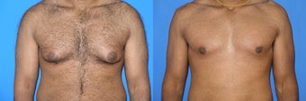 Male breast reduction (gynecomastia) before 177750