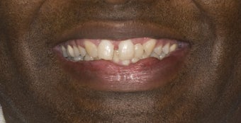 Porcelain Crowns before 374775
