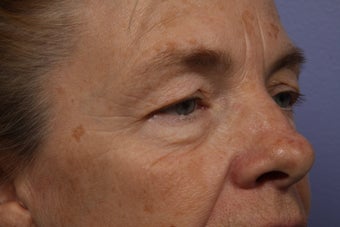 Eyelid Surgery before 324137
