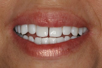 KOR Whitening after 370142