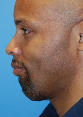 Chin implant after 199377