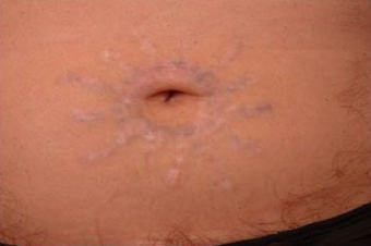 QSR Ruby Laser Tattoo Removal after 329675