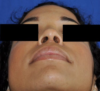 African American Rhinoplasty after 364921