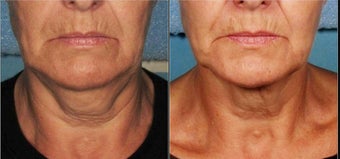 Ultherapy before 460629