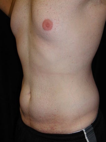 Male Tummy Tuck, Flank Liposuction, Male Breast Reduction 578191