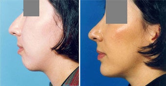 Chin Implant before 643005