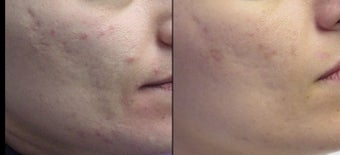 Aesthera Isolaze for acne before 109823