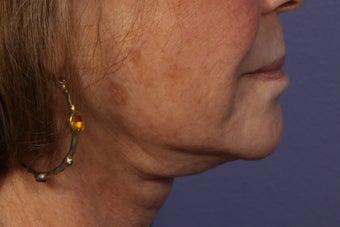 Botox to Neck (Platysmal Band Muscles) before 445465