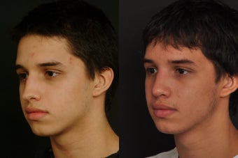 Rhinoplasty 305995