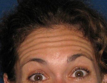 Botox before 206154