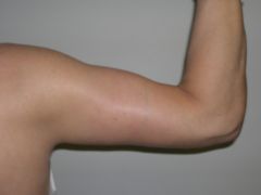 Arm Lift after 259013