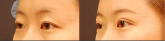 Double Eyelid Surgery Non-Incision before 451350