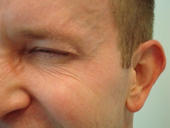 Botox- Crow's Feet after 610484