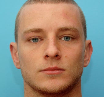 Otoplasty after 271701