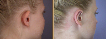 Ear Surgery before 272291