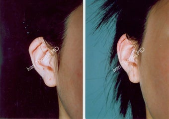Ear Surgery before 243313