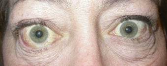 Orbital Decompression with Fat and Bone Removal before 246134
