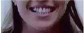 Invisalign before 109369