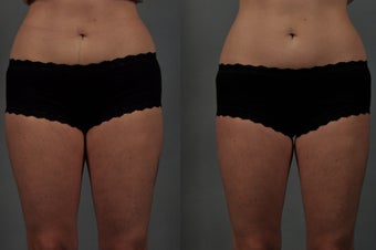 CoolSculpting of the Inner Thighs before 549795