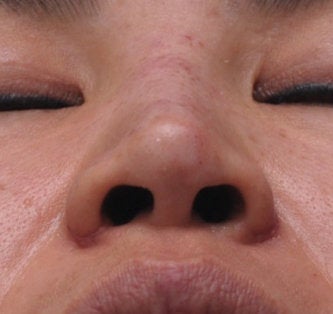 Non Surgical Rhinoplasty 308293