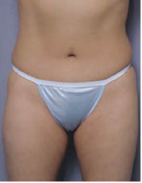 Abdominoplasty after 428196