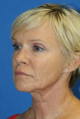 Facelift, Fat Transfer, and Skin Pinch 398946