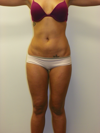 SMARTLIPO MPX after 235398
