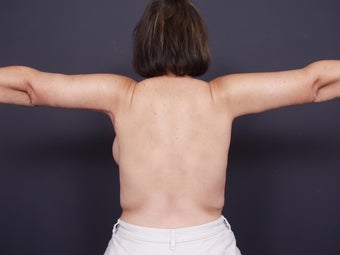 42 year old with sagging arm skin after 626307