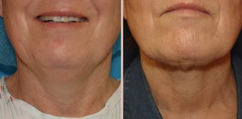 Jawline / Neck Lipo before 293425