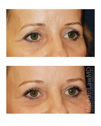 Brow Lift 495496