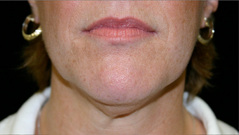 neck liposuction before 238511