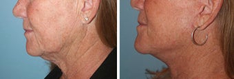 Neck lift before 252451