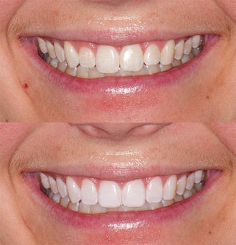 Invisalign with tissue corrections & whitening before 324496