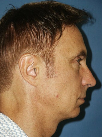 Chin augmentation, bilateral upper and lower blepharoplasty with canthopexy, and soft tissue fillers to the nasolabial folds before 250251