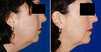 Chin Implant before 495865