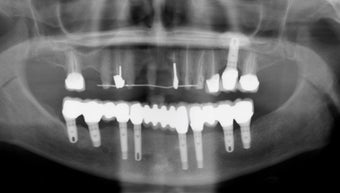 Full mouth dental implants with fixed porcelain bridge 364687