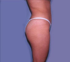 Smartlipo 401661