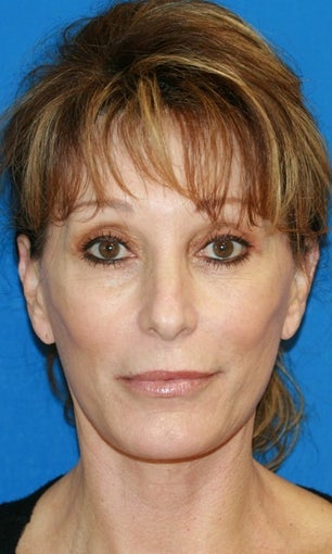 Facelift with Extended Necklift and Upper Blepharoplasty after 641627