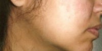 Acne Treatment with Smoothbeam after 271998