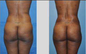 Buttock Augmentation before 271483