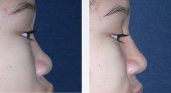 Rhinoplasty before 346240