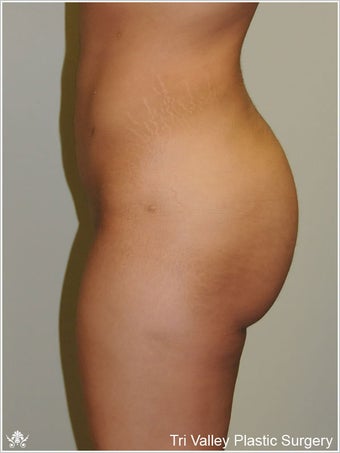 Brazilian Buttock Lift after 420876