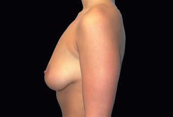 Breast augmentation and vertical mastopexy 391300