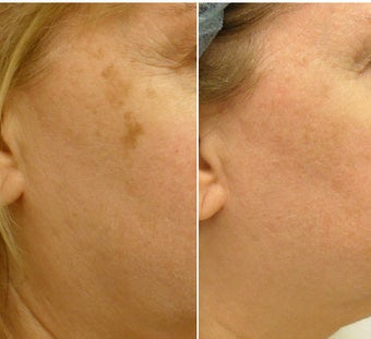Fractionated resurfacing, QS Alexandrite laser, V-Beam laser before 247186