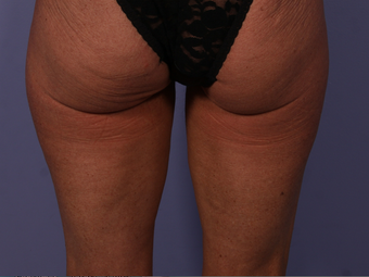 CoolSculpting to Banana Roll, Upper Posterior Thighs after 563822