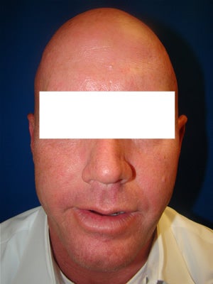 Ear Surgery (otoplasty) after 135827