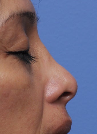 Non Surgical Rhinoplasty 407855